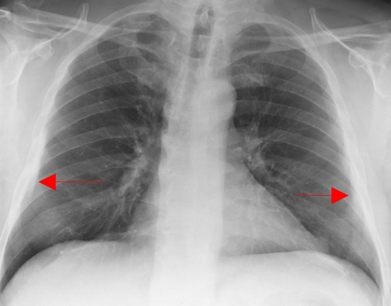 subpleural fat