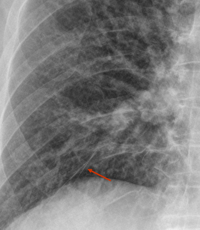inf access fissure