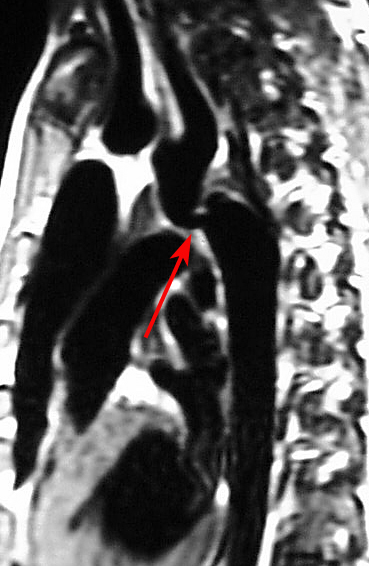 Coarc MRI (G.Culham)