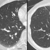 CT supine and prone