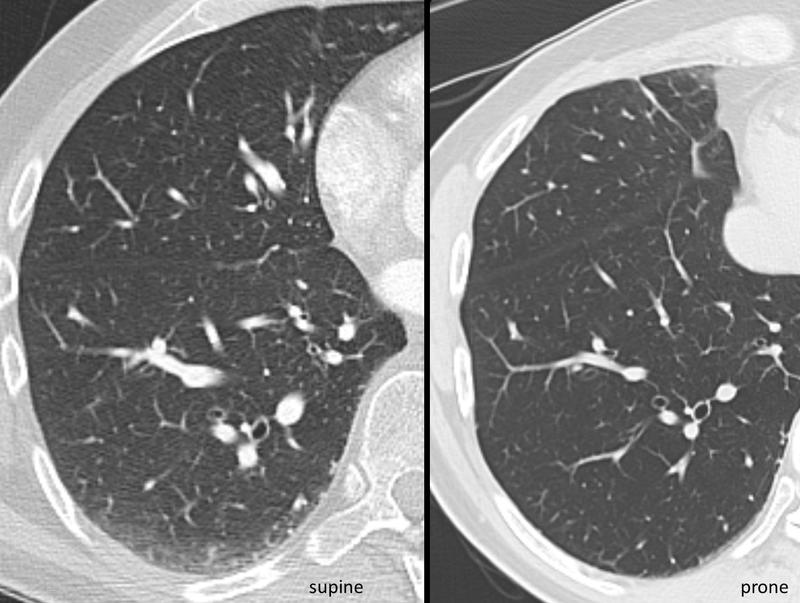 CT supine and prone