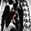 Coarc MRI (G.Culham)