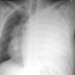 Pleural