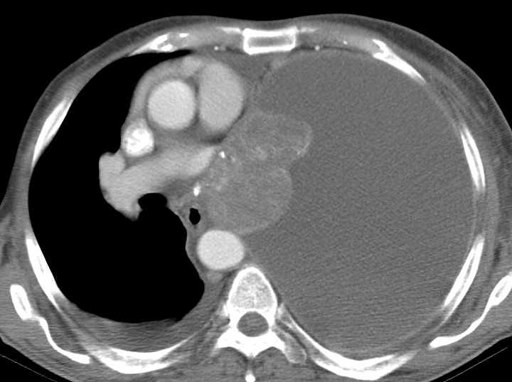 huge effusion CT