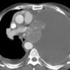 huge effusion CT