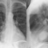 fluid in major fissure (pseudotumour)