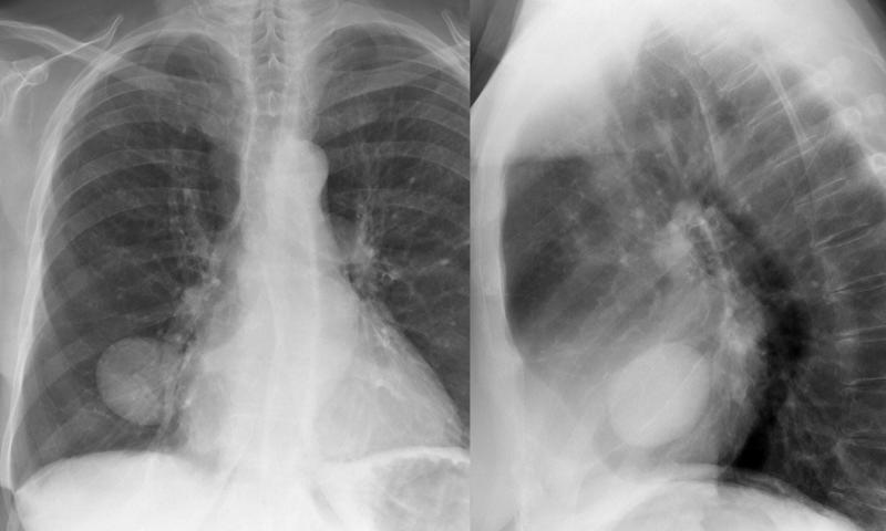 fluid in major fissure (pseudotumour)