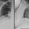 Subpulmonic effusion