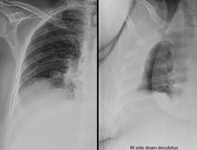 Subpulmonic effusion