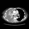 malignant effusion (pleural mets)