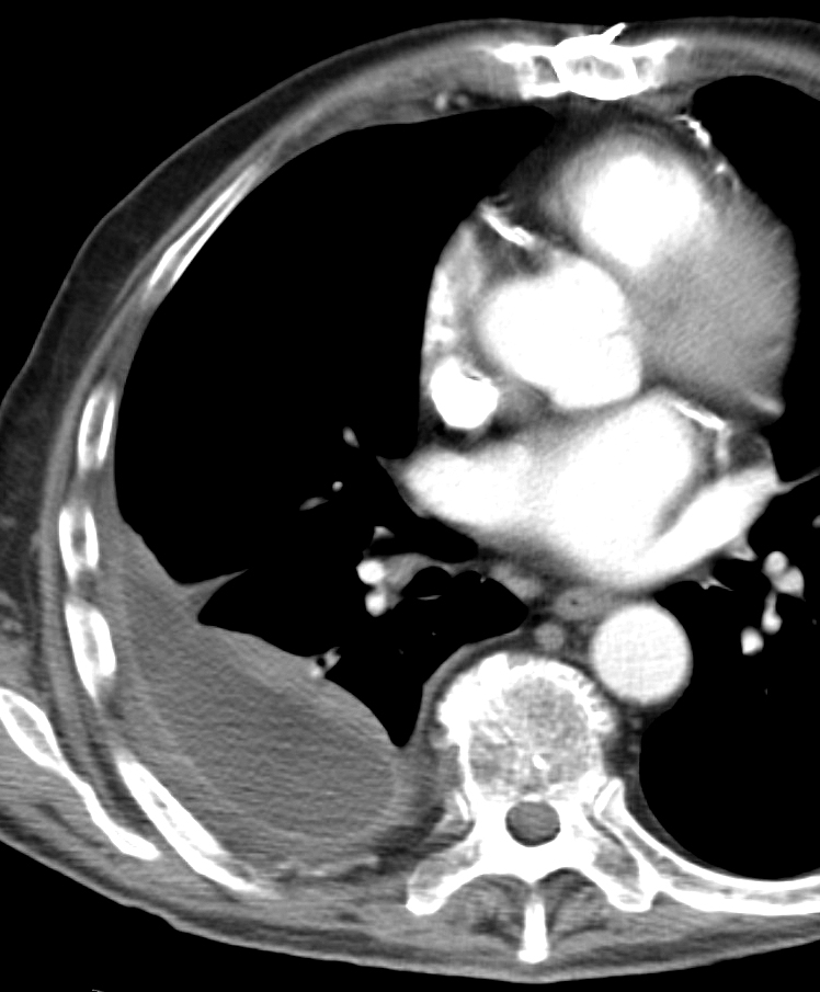 pleural empyema ct