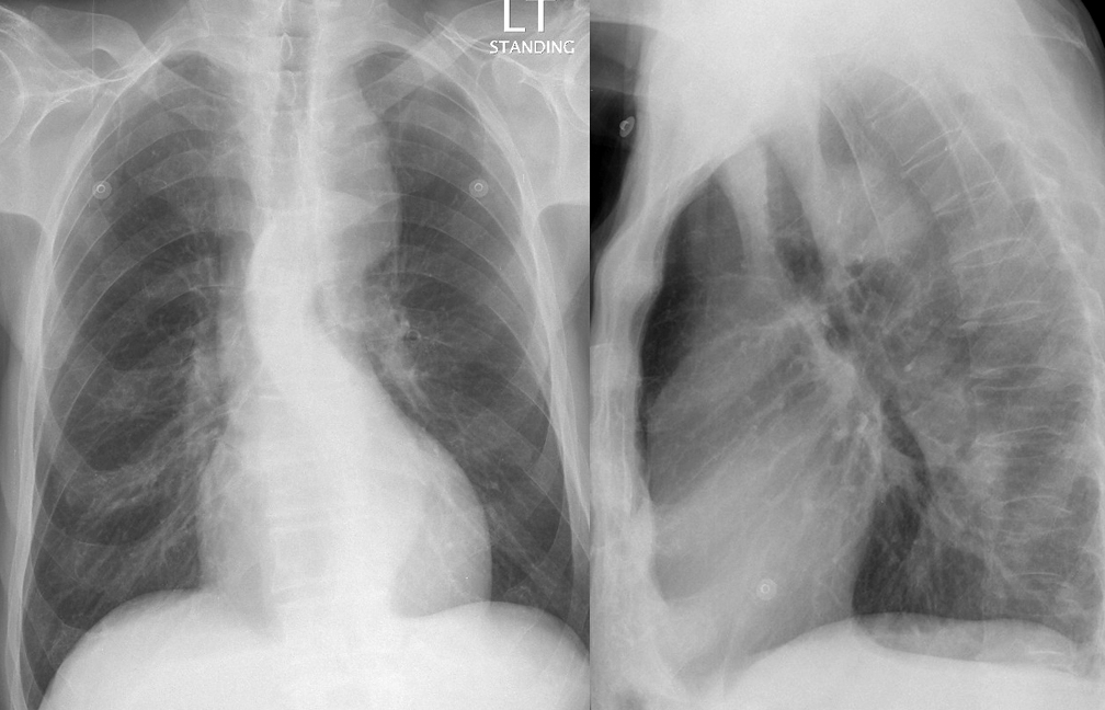 PseudoCoarc 1c