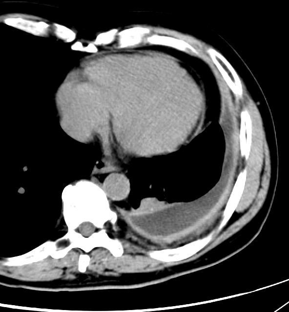 empyema split pleura