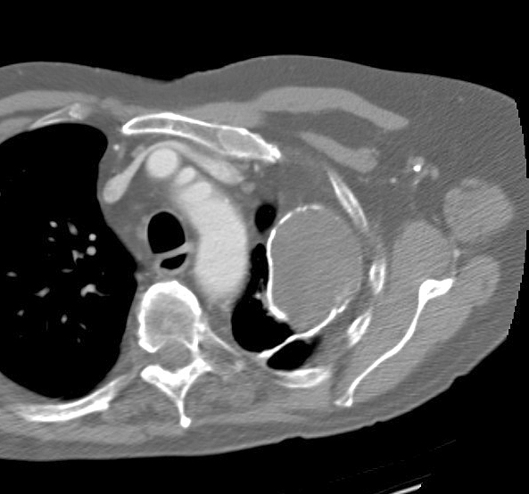 calcified emp CT