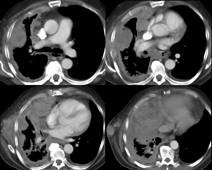 mesothelioma CT