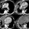 mesothelioma CT