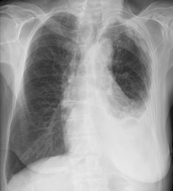 mesothelioma 2a