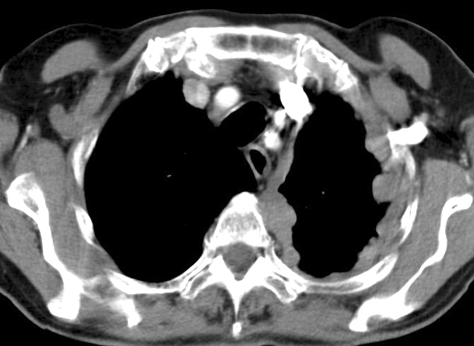 mesothelioma 2b