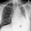 mesothelioma 3a
+plaques