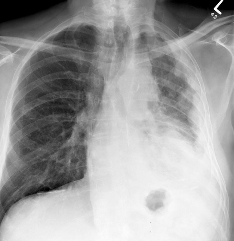 mesothelioma 3a
+plaques