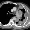 mesothelioma 3B
+ plaques CT