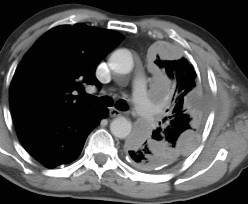 mesothelioma 3B
+ plaques CT