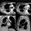 Mesothelioma 4 CT