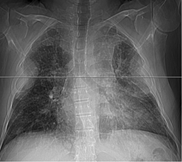 renal mets