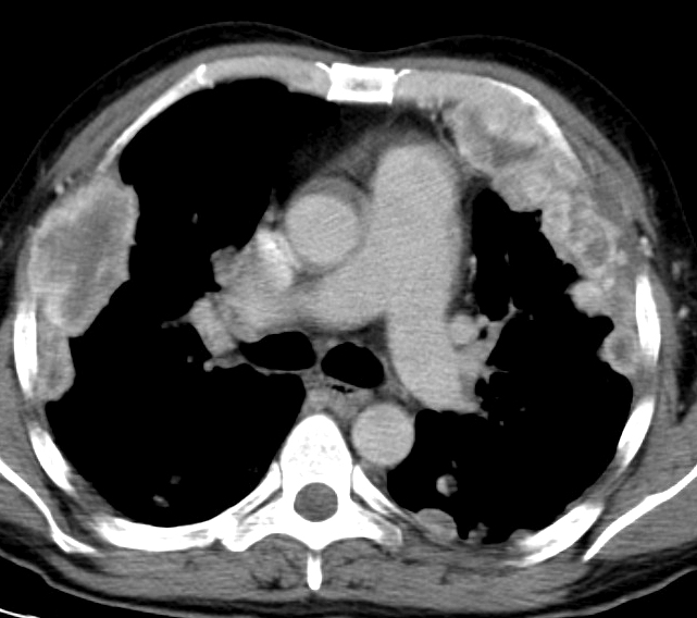 renal mets