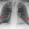 subpleural fat