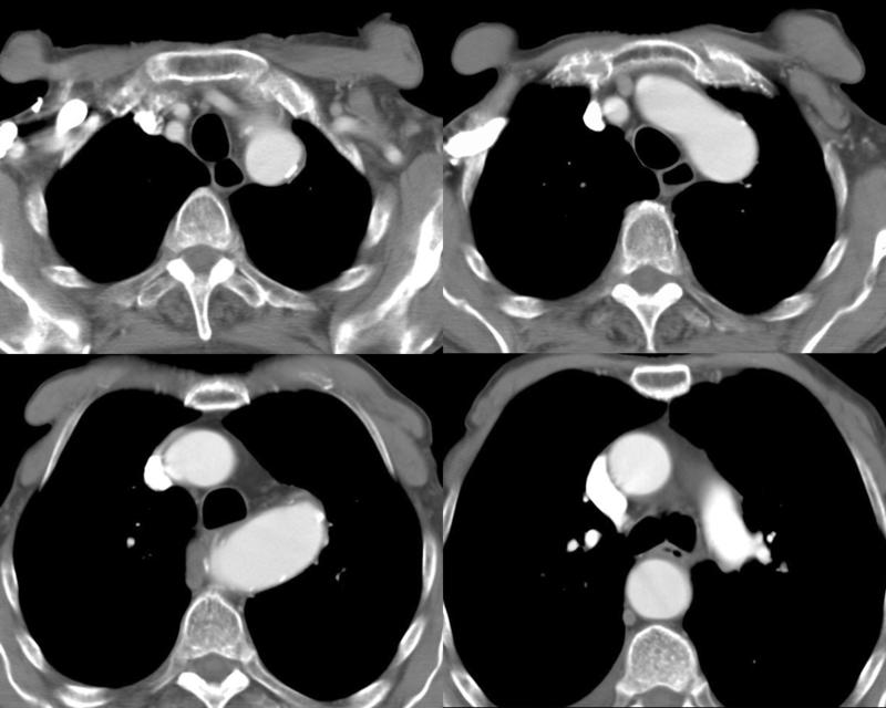 PseudoCoarc 1d