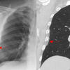 subpleural fat