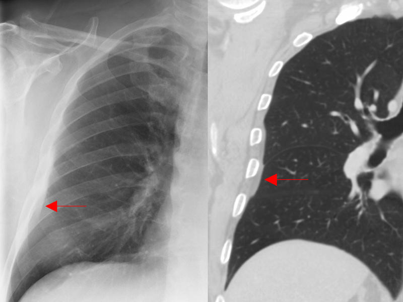 subpleural fat