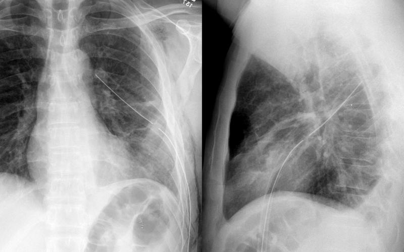 chest tube in fissure