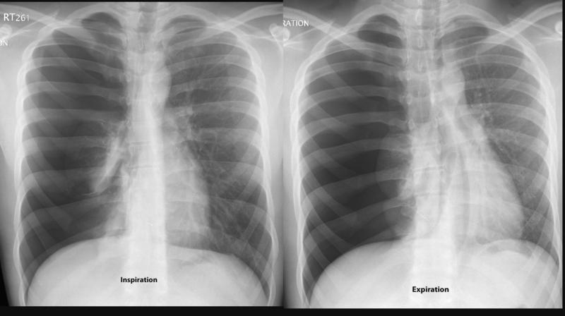 Pneumo insp/exp
(similar - mild tension)