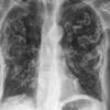 Asbestos- calcified plaques