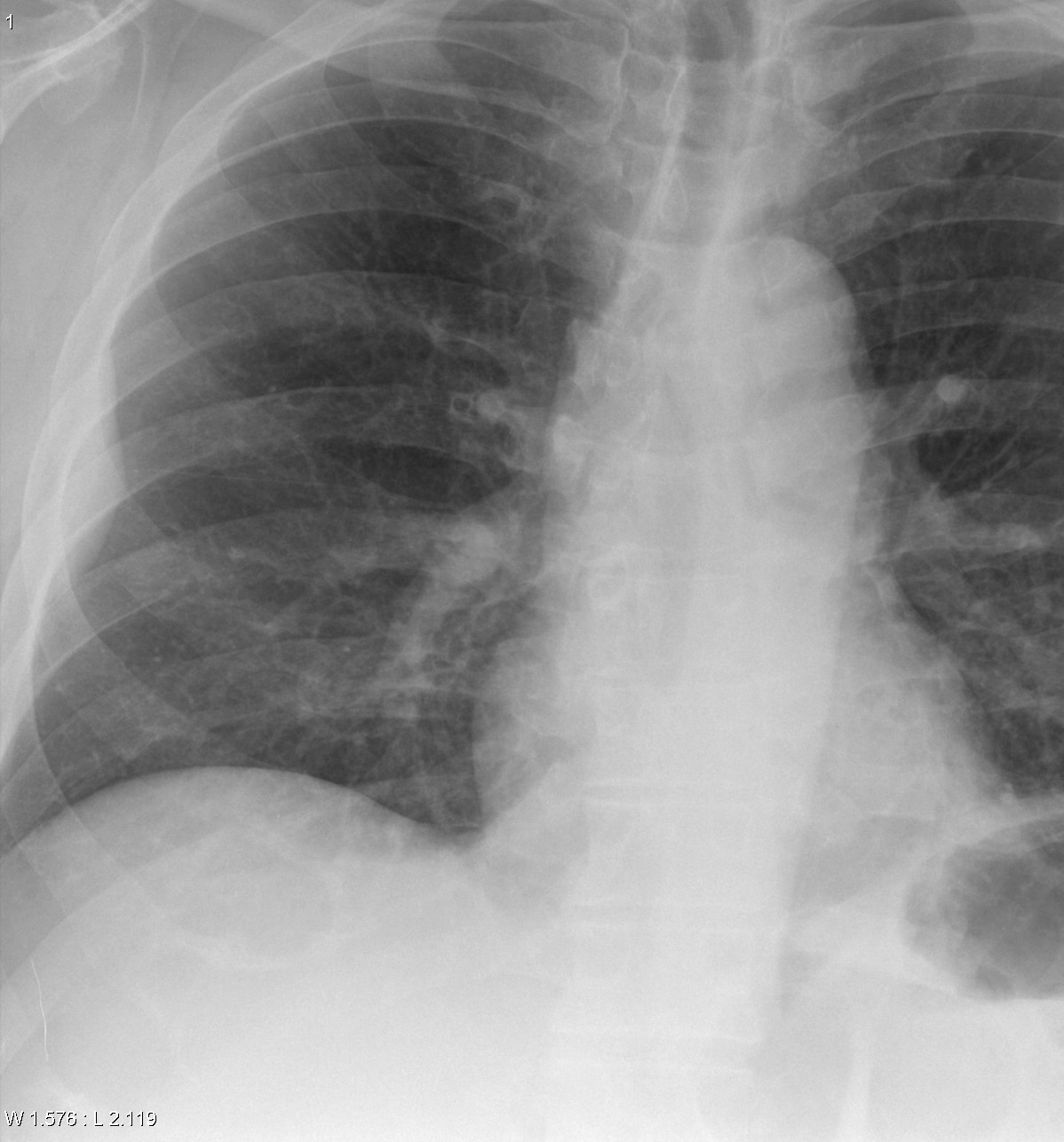 pleural lipoma