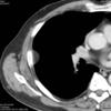 pleural lipoma CT