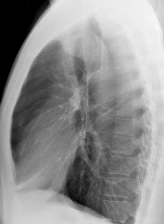 PseudoCoarc 2b