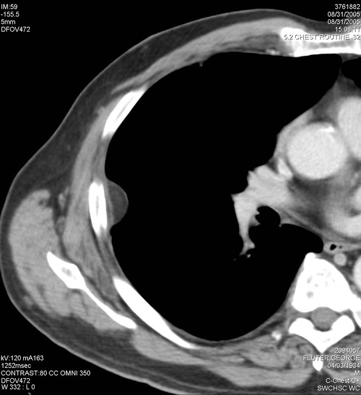 pleural lipoma CT