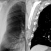 subpleural chest wall fat