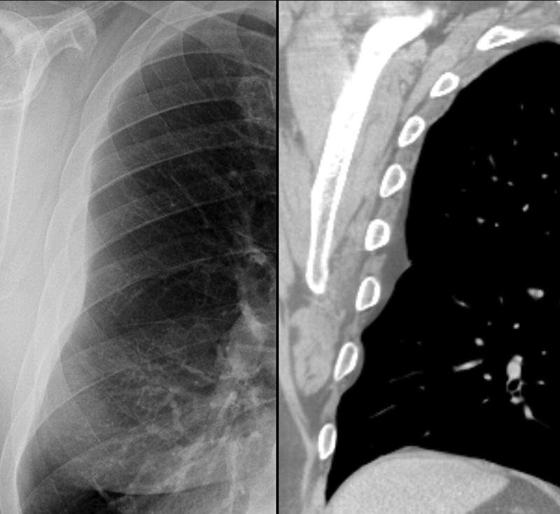 subpleural chest wall fat