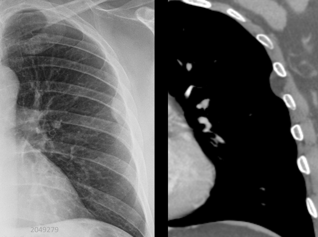 pleural lipoma