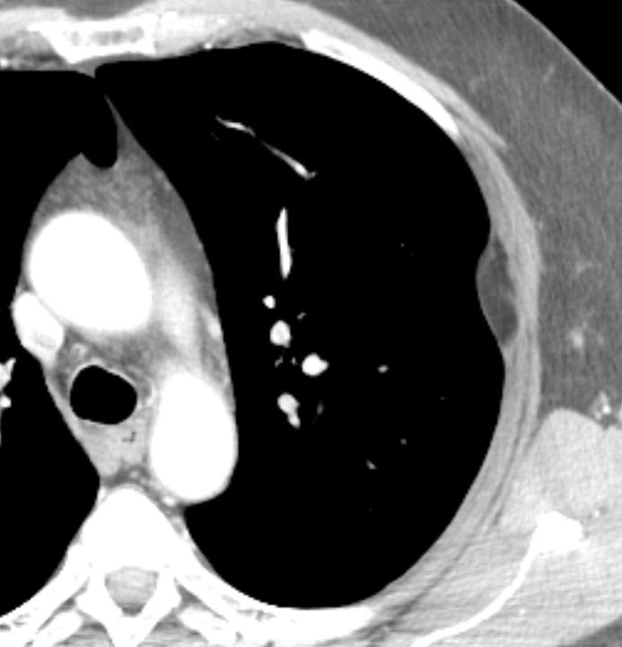 pleural lipoma axial CT