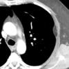 pleural lipoma axial CT