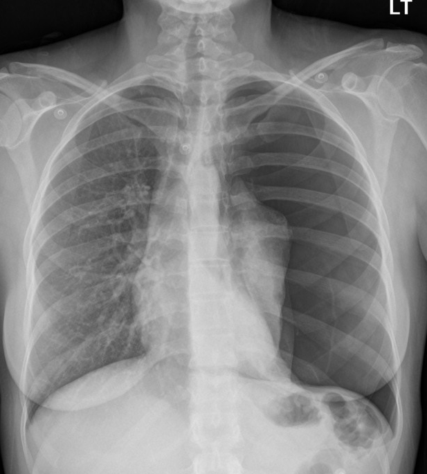 spont tension pneumothorax- 