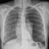 spont tension pneumothorax- 