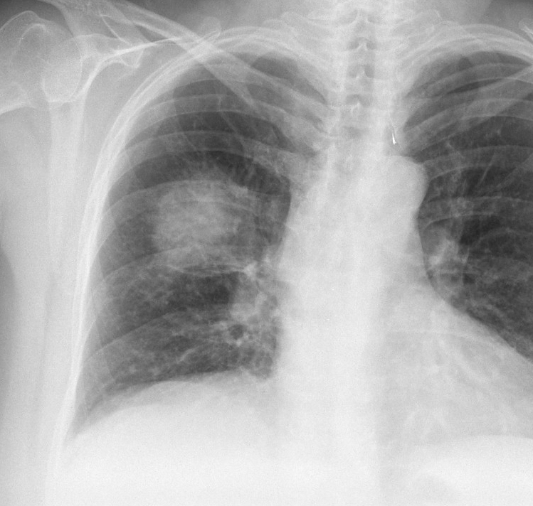 Case 1 Round pneumonia