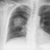 Case 1 Round pneumonia