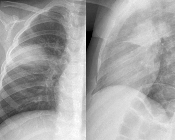 Round pneumonia 
different case